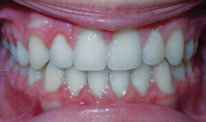 After: Patient with spacing and an overbite